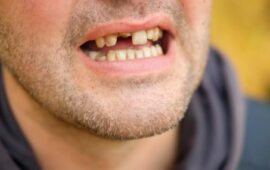 Англичани вадят зъбите си с клещи, стоматолозите на Острова са на изчезване