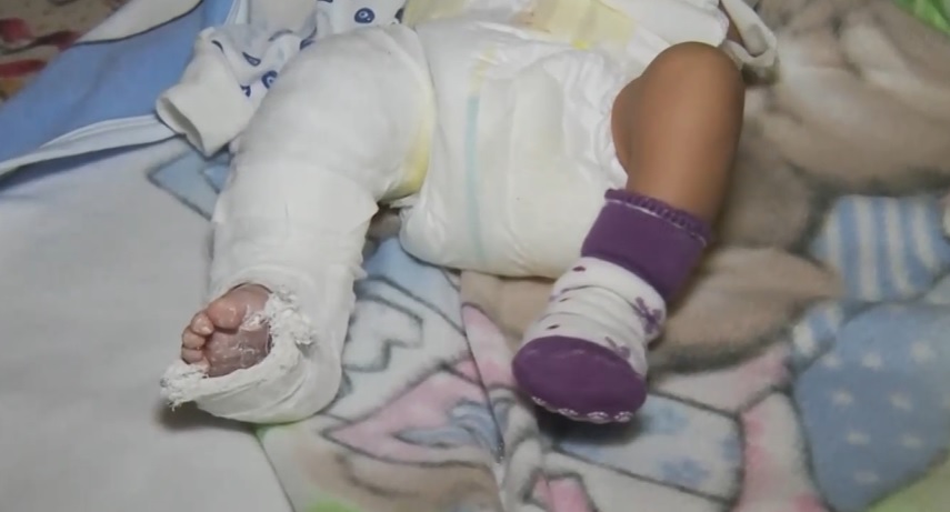 Бебе влиза в болница с жълтеница, излиза със счупен крак